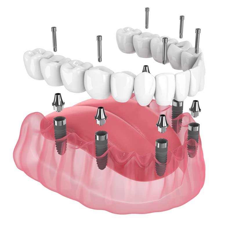 Full Arch Rehabilitation